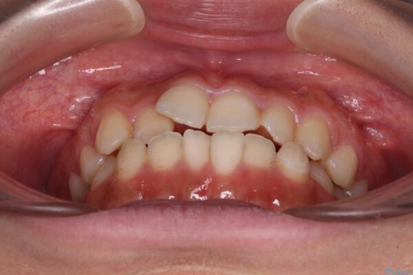 【モニター】短期間で終わりたい　ワイヤー装置での非抜歯矯正 治療前画像