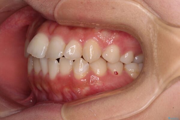 【モニター】短期間で終わりたい　ワイヤー装置での非抜歯矯正 治療前画像