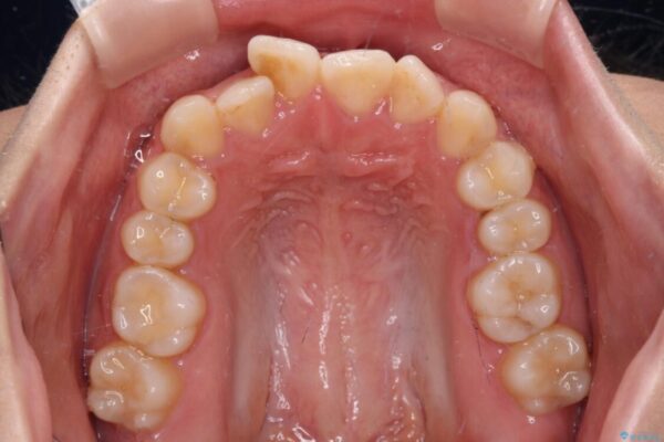 【モニター】短期間で終わりたい　ワイヤー装置での非抜歯矯正 治療前画像
