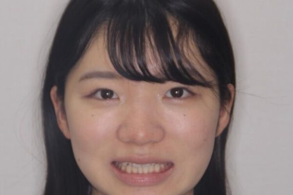 【モニター】短期間で終わりたい　ワイヤー装置での非抜歯矯正 治療前画像