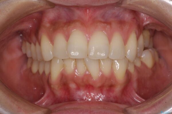 インビザラインによる矯正治療と奥歯のインプラント治療 治療前画像