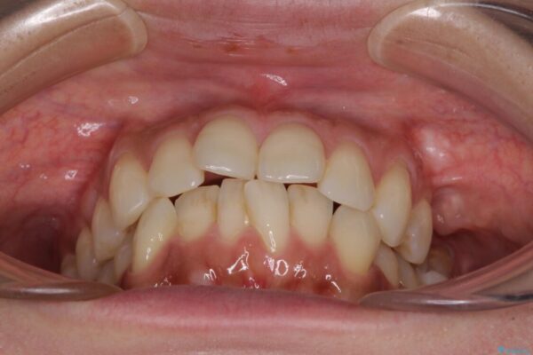 インビザラインによる矯正治療と奥歯のインプラント治療 治療前画像