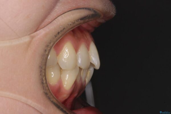 インビザラインによる矯正治療と奥歯のインプラント治療 治療前画像