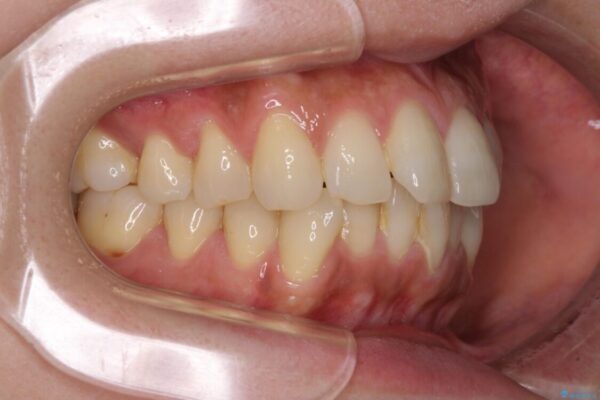 インビザラインによる矯正治療と奥歯のインプラント治療 治療前画像