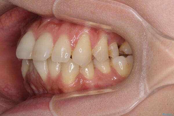 インビザラインによる矯正治療と奥歯のインプラント治療 治療前画像