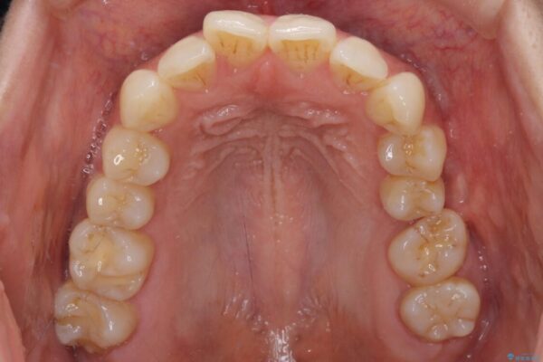 インビザラインによる矯正治療と奥歯のインプラント治療 治療前画像