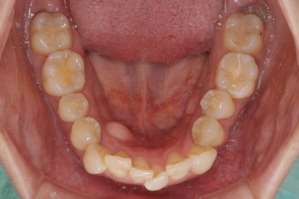 インビザラインによる矯正治療と奥歯のインプラント治療 治療前画像
