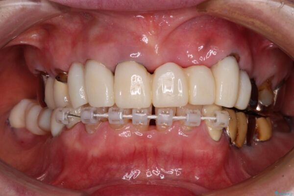 前歯をきれいにしたい　インプラントや部分矯正を用いた総合歯科治療 治療途中画像