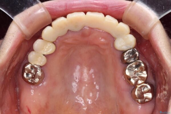 前歯をきれいにしたい　インプラントや部分矯正を用いた総合歯科治療 治療途中画像