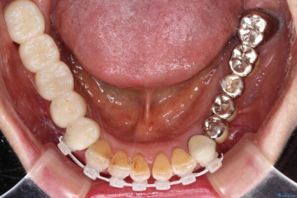 前歯をきれいにしたい　インプラントや部分矯正を用いた総合歯科治療 治療途中画像