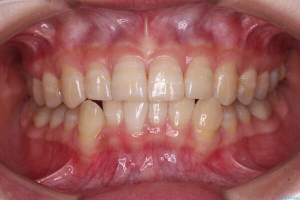 【モニター】下顎前歯のデコボコをインビザラインできれいに ビフォー