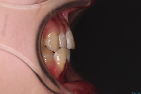 【モニター】下顎前歯のデコボコをインビザラインできれいに 治療前画像