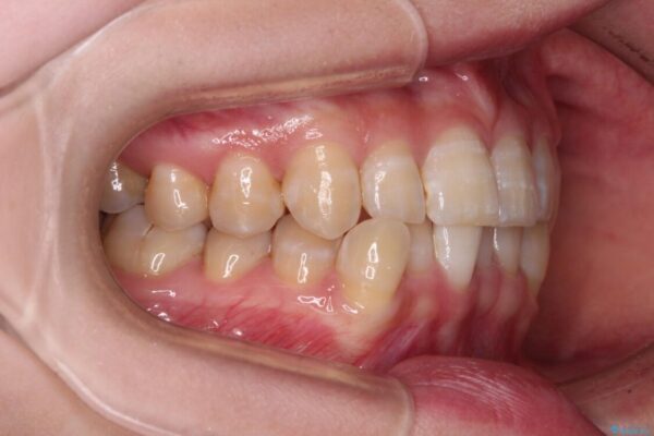 【モニター】下顎前歯のデコボコをインビザラインできれいに 治療前画像