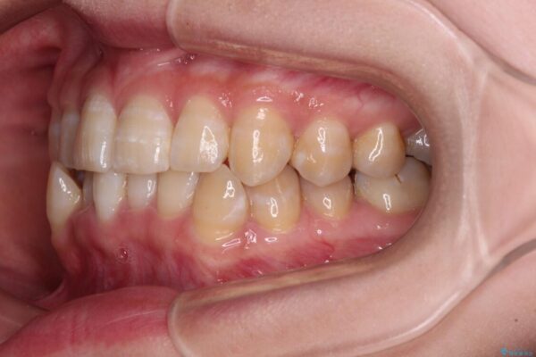 【モニター】下顎前歯のデコボコをインビザラインできれいに 治療前画像