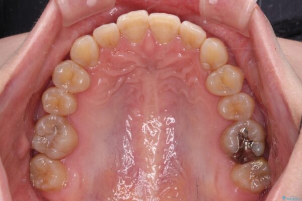 【モニター】下顎前歯のデコボコをインビザラインできれいに 治療前画像