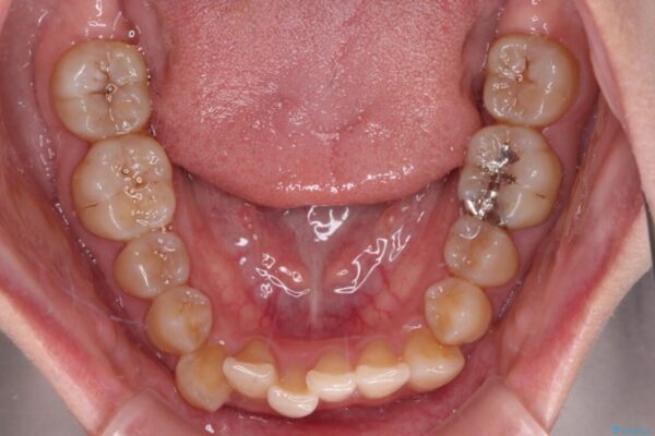 【モニター】下顎前歯のデコボコをインビザラインできれいに 治療前画像