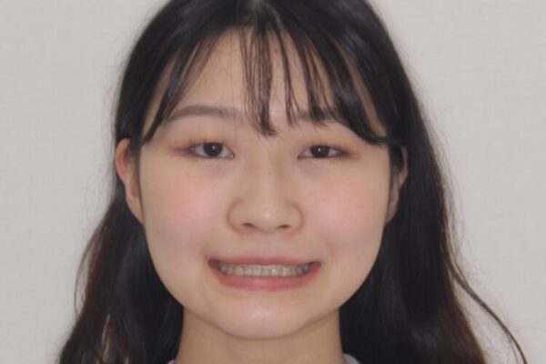 【モニター】下顎前歯のデコボコをインビザラインできれいに 治療前画像