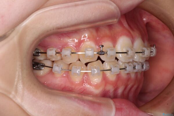 インビザラインは使える自信がない　ワイヤー装置にて矯正治療 治療途中画像