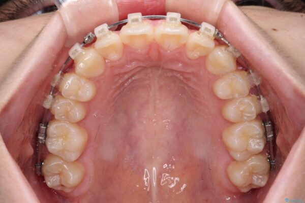 インビザラインは使える自信がない　ワイヤー装置にて矯正治療 治療途中画像