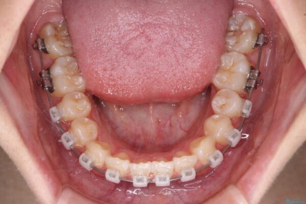 インビザラインは使える自信がない　ワイヤー装置にて矯正治療 治療途中画像