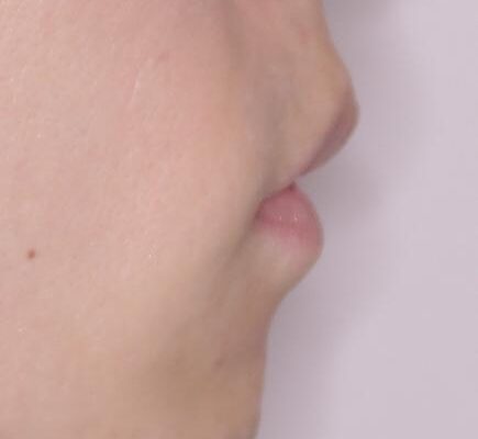 口元の突出感を改善!目立ちにくいワイヤー矯正で自信を持てる自然な横顔に 治療後画像