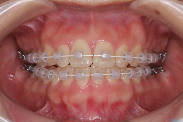 目立ちにくい表側装置で1年完了!狭いアーチを側方拡大し前歯のデコボコを整えた症例 治療途中画像