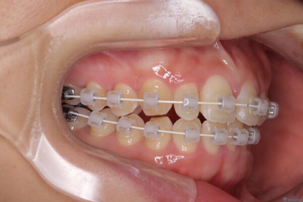 目立ちにくい表側装置で1年完了!狭いアーチを側方拡大し前歯のデコボコを整えた症例 治療途中画像
