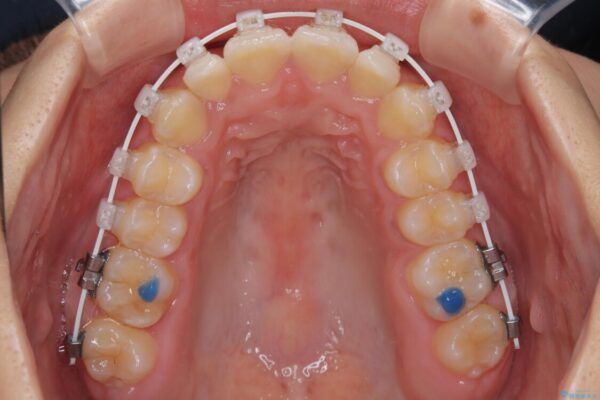 目立ちにくい表側装置で1年完了!狭いアーチを側方拡大し前歯のデコボコを整えた症例 治療途中画像