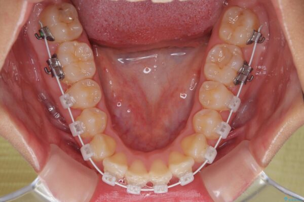目立ちにくい表側装置で1年完了!狭いアーチを側方拡大し前歯のデコボコを整えた症例 治療途中画像