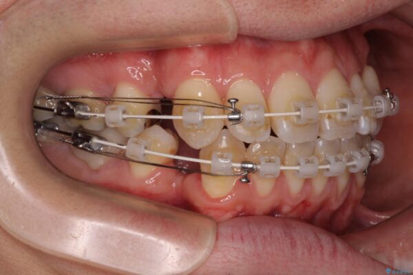 口元の突出感を改善!目立ちにくいワイヤー矯正で自信を持てる自然な横顔に 治療途中画像