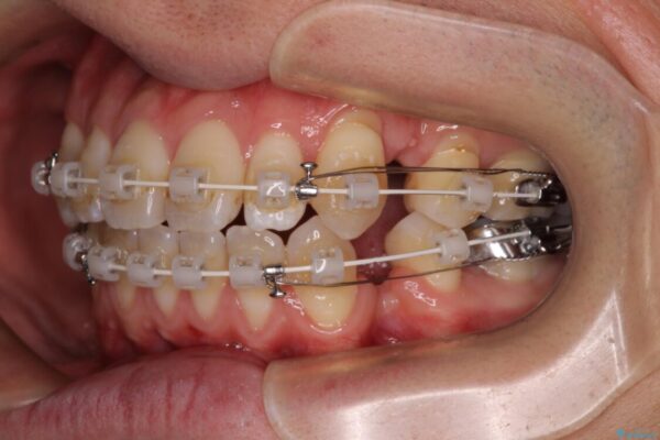 口元の突出感を改善!目立ちにくいワイヤー矯正で自信を持てる自然な横顔に 治療途中画像