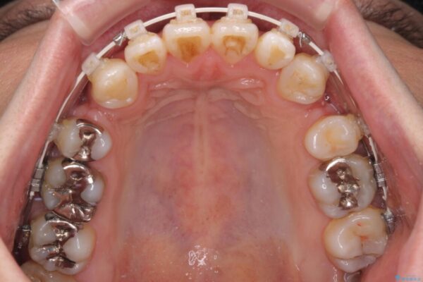 口元の突出感を改善!目立ちにくいワイヤー矯正で自信を持てる自然な横顔に 治療途中画像
