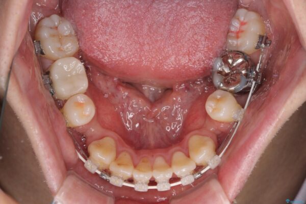 口元の突出感を改善!目立ちにくいワイヤー矯正で自信を持てる自然な横顔に 治療途中画像