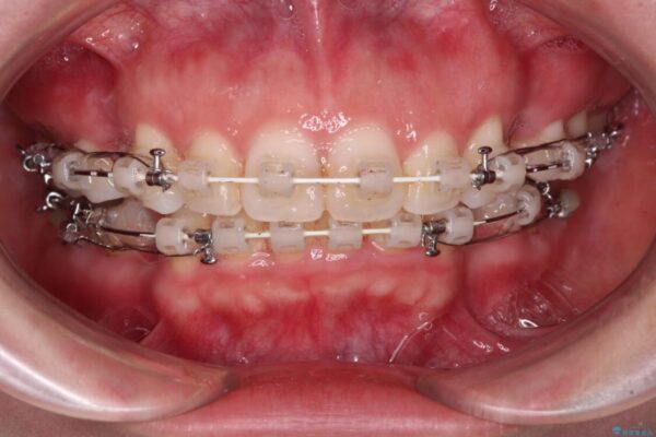 【モニター】出っ歯と咬み合わせを改善　ワイヤー装置の抜歯矯正 治療途中画像