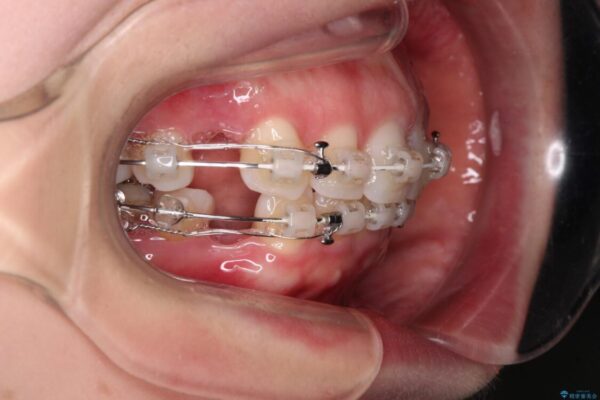 【モニター】出っ歯と咬み合わせを改善　ワイヤー装置の抜歯矯正 治療途中画像