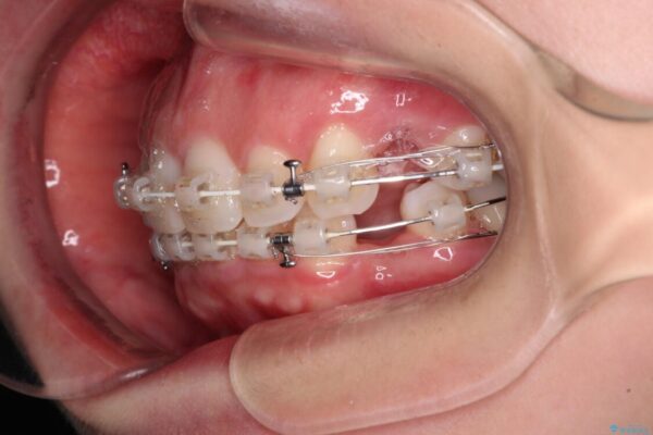 【モニター】出っ歯と咬み合わせを改善　ワイヤー装置の抜歯矯正 治療途中画像