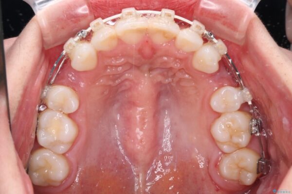 【モニター】出っ歯と咬み合わせを改善　ワイヤー装置の抜歯矯正 治療途中画像