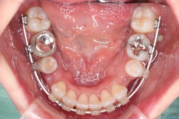 【モニター】出っ歯と咬み合わせを改善　ワイヤー装置の抜歯矯正 治療途中画像