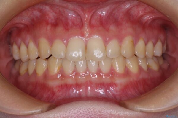 治療途中の奥歯と矯正治療の後戻り　インビザライン・ライトによる矯正治療 治療途中画像