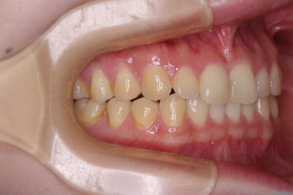 治療途中の奥歯と矯正治療の後戻り　インビザライン・ライトによる矯正治療 治療途中画像