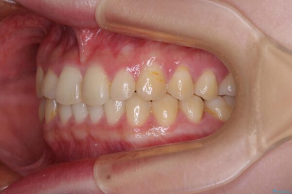 治療途中の奥歯と矯正治療の後戻り　インビザライン・ライトによる矯正治療 治療途中画像
