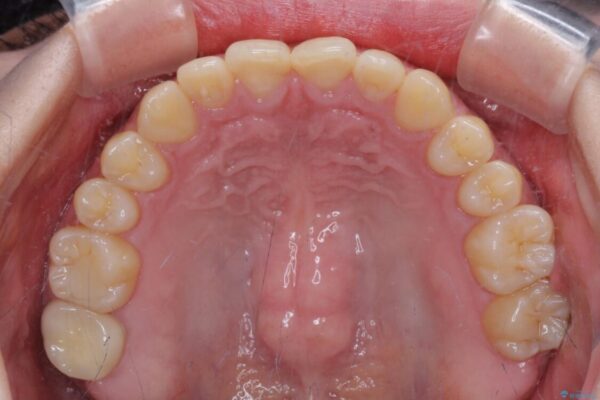 治療途中の奥歯と矯正治療の後戻り　インビザライン・ライトによる矯正治療 治療途中画像