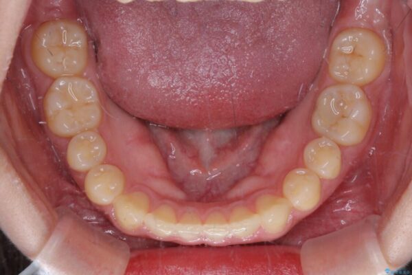 治療途中の奥歯と矯正治療の後戻り　インビザライン・ライトによる矯正治療 治療途中画像