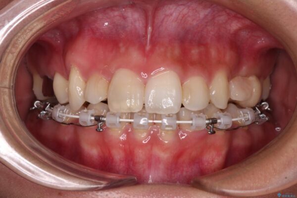 気になる八重歯　目立ちにくいハーフリンガルでの抜歯矯正 治療途中画像