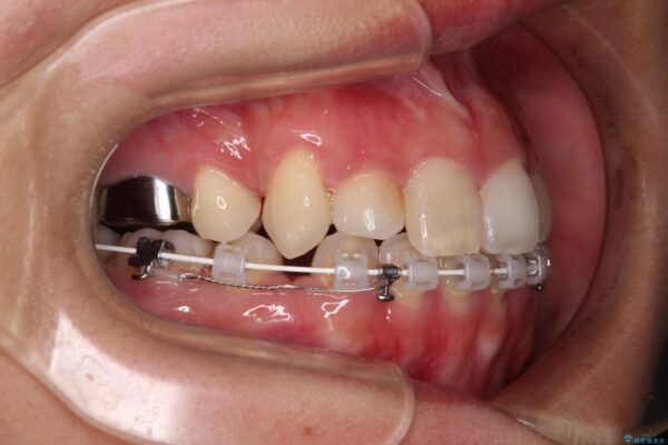 気になる八重歯　目立ちにくいハーフリンガルでの抜歯矯正 治療途中画像