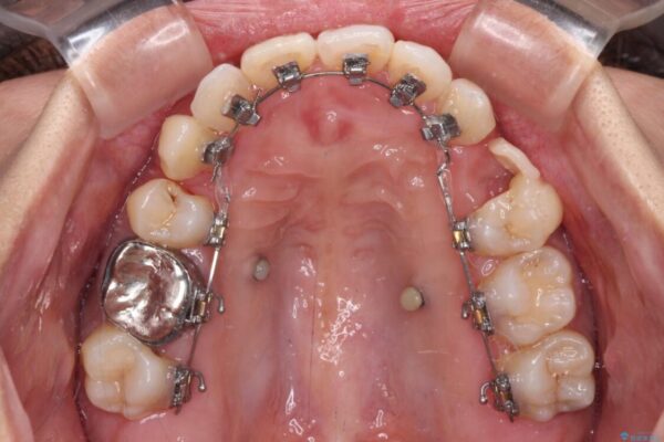 気になる八重歯　目立ちにくいハーフリンガルでの抜歯矯正 治療途中画像