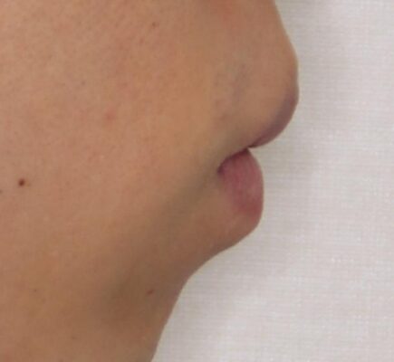 口元の突出感を改善!目立ちにくいワイヤー矯正で自信を持てる自然な横顔に 治療前画像