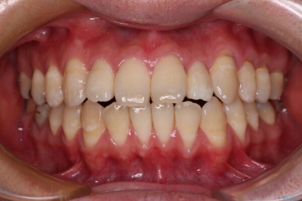 口元の突出感を改善!目立ちにくいワイヤー矯正で自信を持てる自然な横顔に 治療前画像
