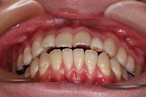 口元の突出感を改善!目立ちにくいワイヤー矯正で自信を持てる自然な横顔に 治療前画像