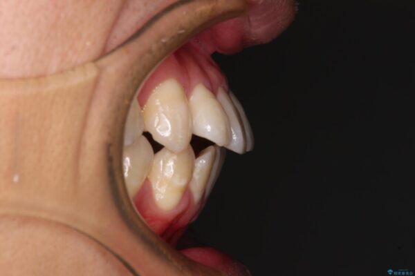 口元の突出感を改善!目立ちにくいワイヤー矯正で自信を持てる自然な横顔に ビフォー